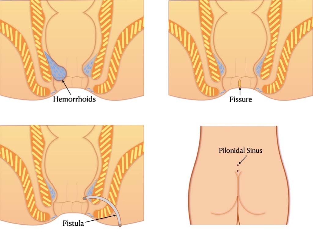 Common proctological conditions and their management