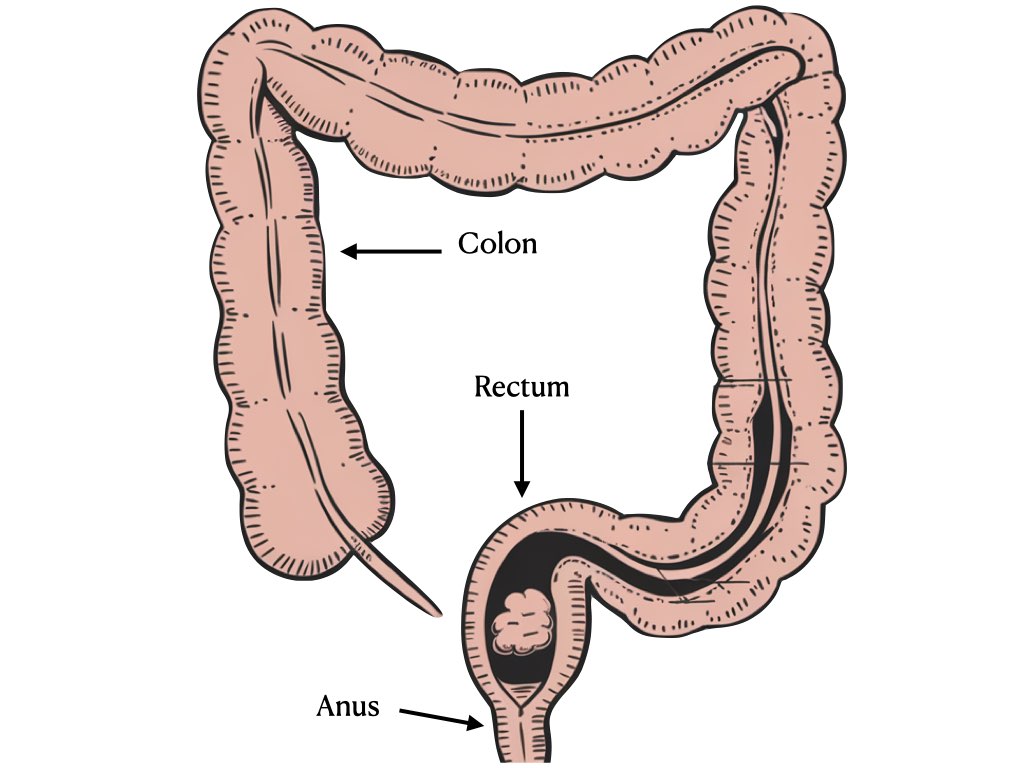 Healthy diet and lifestyle for hemorrhoids management